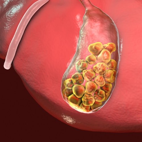 Gallstone Development - Healix Hospitals