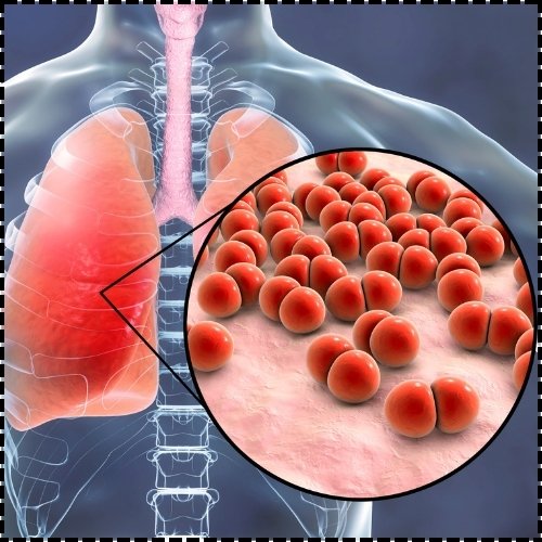 Pneumonia - Healix Hospitals